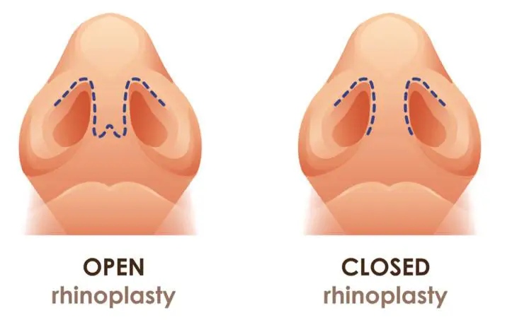 Open vs. Closed Rhinoplasty